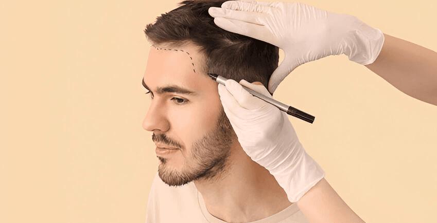 Transplant de Păr și Barbă